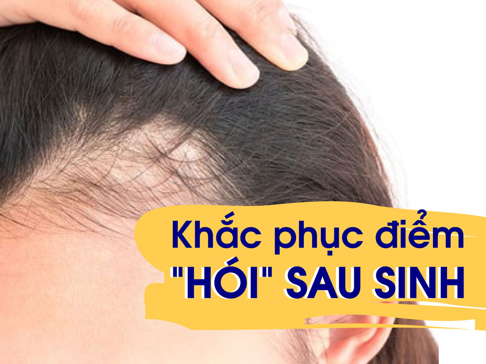 4. Các biện pháp phòng ngừa rụng tóc sau sinh